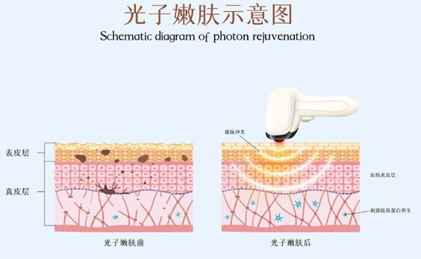 光子嫩膚術(shù)前注意事項(xiàng)有哪些？