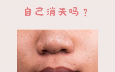 什么是黑頭？怎樣預防黑頭的形成？