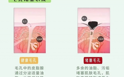 毛孔堵塞怎么疏通毛孔？